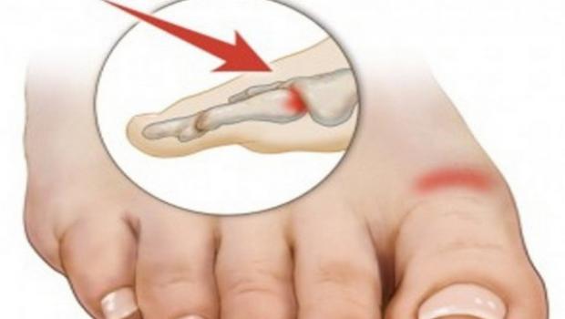What to do at home with a bruised toe